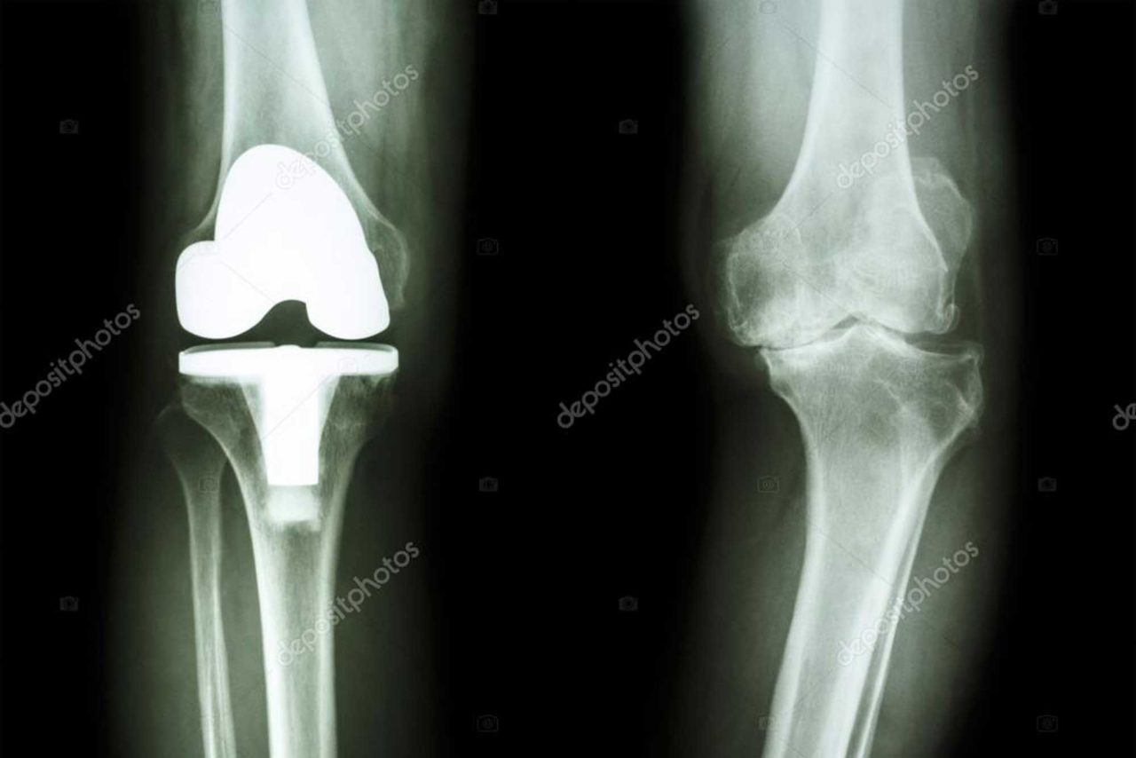 Nuovi percorsi per la patologia protesica, del ginocchio e del piede