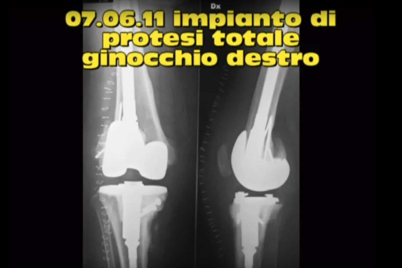 Intervento di Protesi bilaterale in grave deformità delle ginocchia