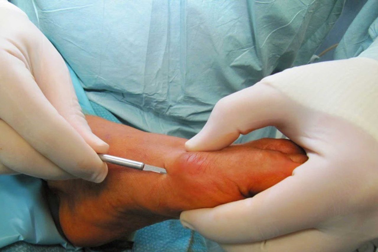 La chirurgia percutanea del piede