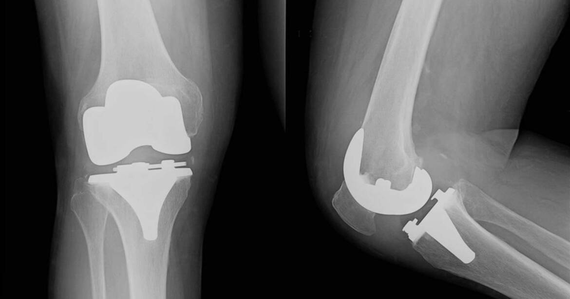 La chirurgia prenavigata del ginocchio