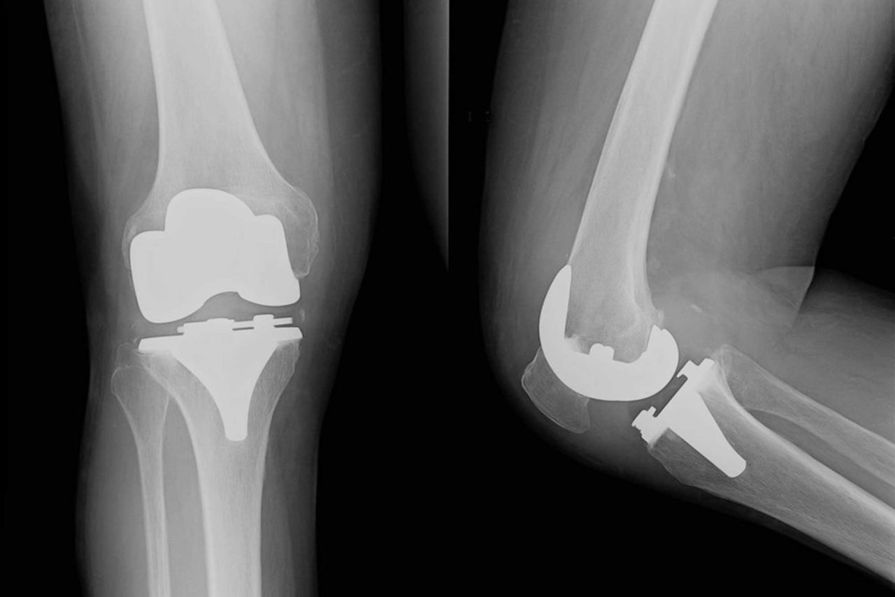 La chirurgia prenavigata del ginocchio