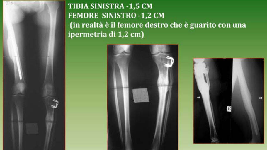 Osteotomia della tibia